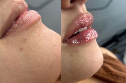 Resultado de antes y después de aumento de labios con ácido hialurónico en Aurora.Esthetic, Ponce.