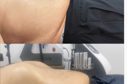 Resultados reales de antes y después de mesoterapia para reducción y firmeza en Aurora.Esthetic, Ponce.