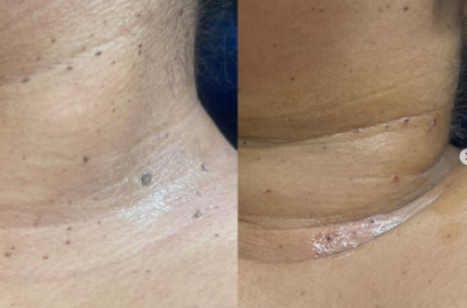 Resultado de antes y después de eliminación de verrugas de forma segura en Aurora.Esthetic, Ponce.