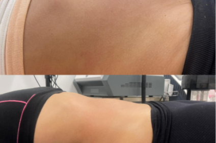 Resultados de maderoterapia para moldeado corporal y reducción de celulitis en Aurora.Esthetic, Ponce.