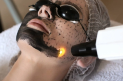 Tratamiento facial Hollywood Carbon Peel con láser para limpieza profunda de poros y rejuvenecimiento de la piel en Bayamón, Puerto Rico.