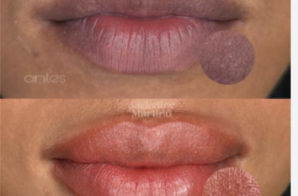 esultado de neutralización de labios oscuros y manchados antes y después del tratamiento con Jackeline Martinó en Bayamón, Puerto Rico.