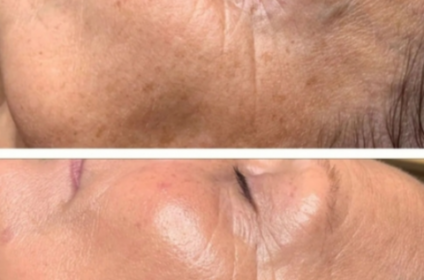 Facial Korean Biolift para levantamiento y firmeza en Original Skin Co Dorado, Puerto Rico.