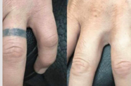 Servicio profesional de remoción de tatuajes con láser en Original Skin Co Dorado.