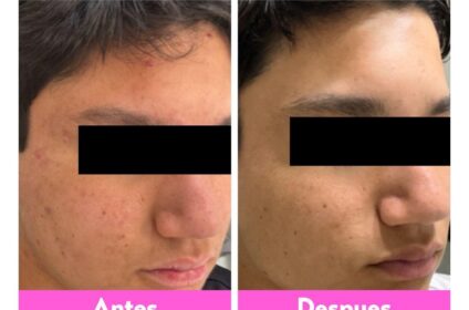 Resultado de antes y después de un tratamiento clínico efectivo para el control del acné en Skin by Susan & Brow Studio