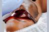 impieza profunda y exfoliación láser con Hollywood Peel en Pure Skin Spa Estetique, Bayamón.