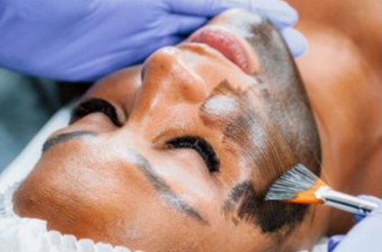 Tratamiento de rejuvenecimiento facial con láser de carbón activo en Pure Skin Spa Estetique, Puerto Rico.